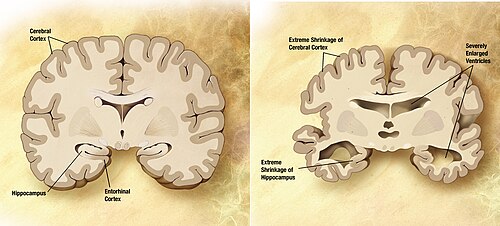 Neurodegenerative diseases